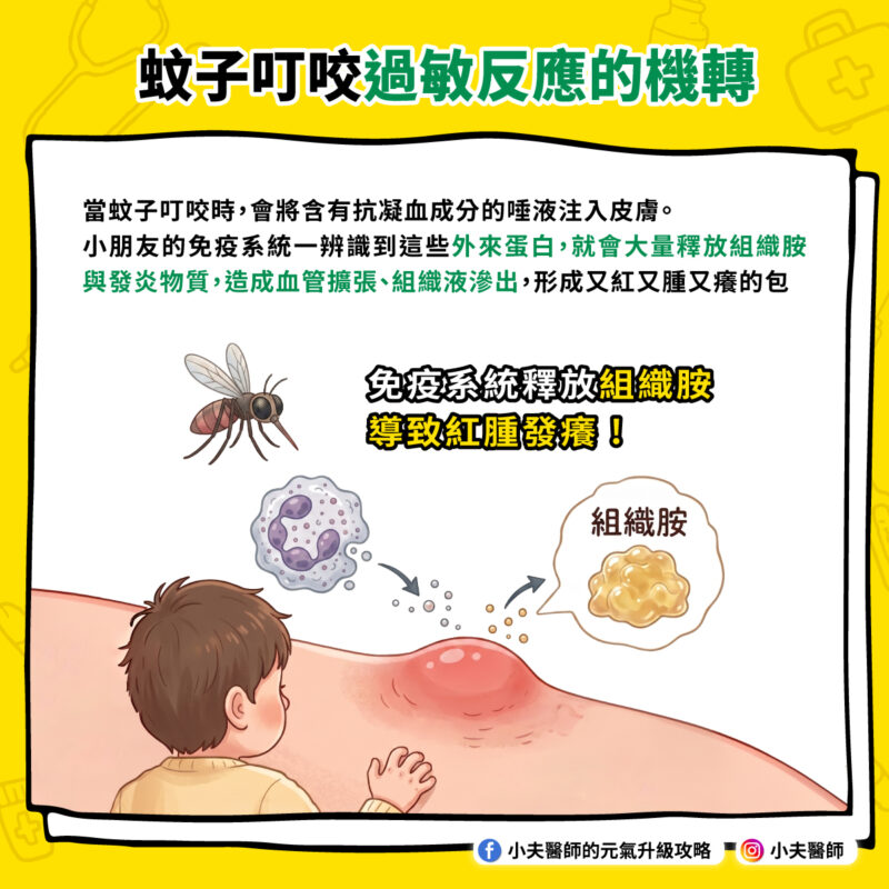 孩子被蚊子叮到腫成包小心不是毒,是過敏! 蚊子咬 過敏